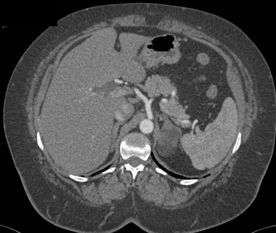 Left Adrenal Myelolipoma - CTisus CT Scan