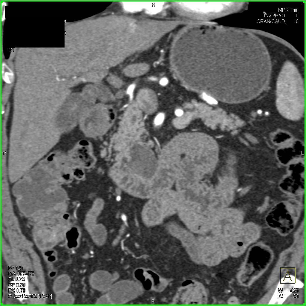 3 cm Intraductal Papillary Mucinous Neoplasm (IPMN) in Head of Pancreas - CTisus CT Scan