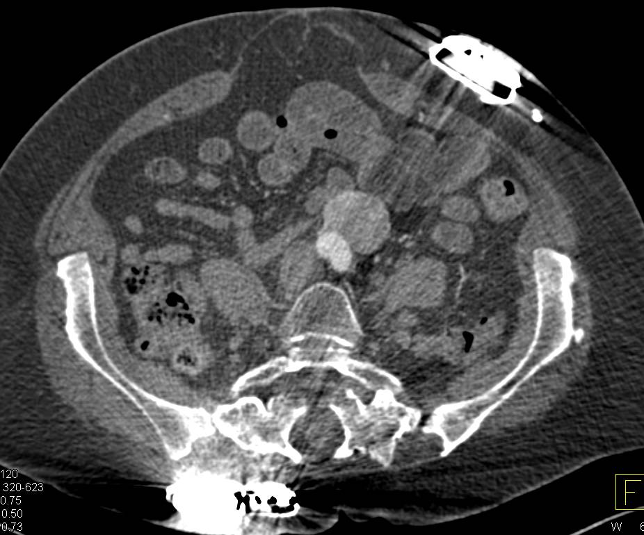 Pheochromocytoma Near Organ of Zuckerkandl - CTisus CT Scan