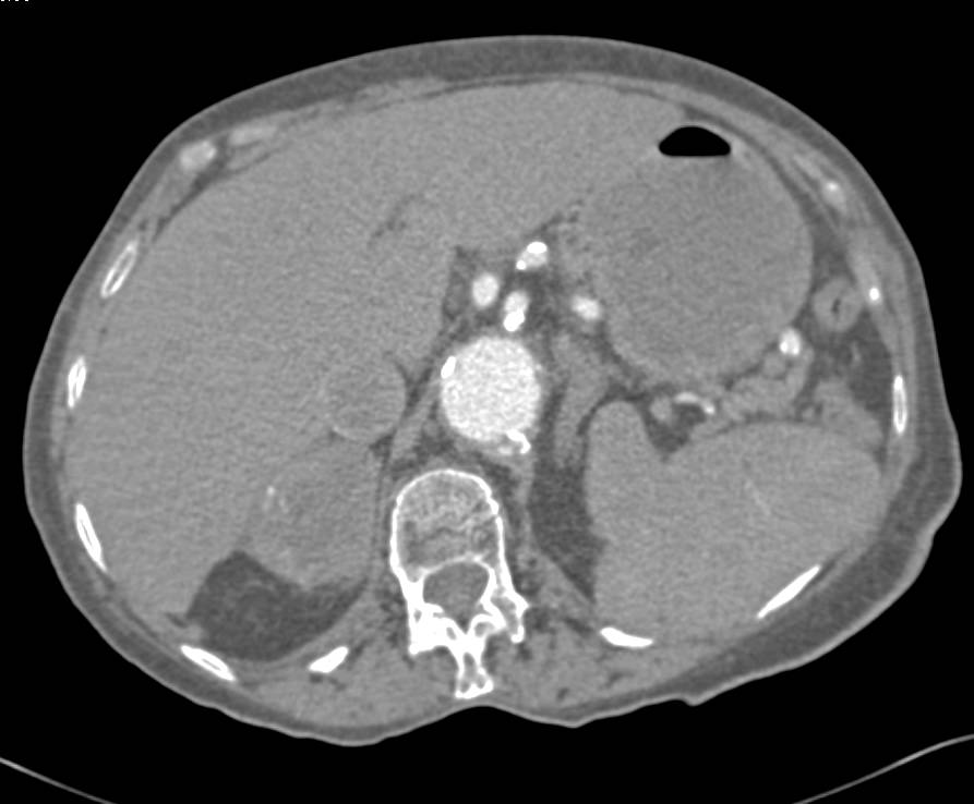 Renal Cell Carcinoma with Adrenal Metastases - CTisus CT Scan