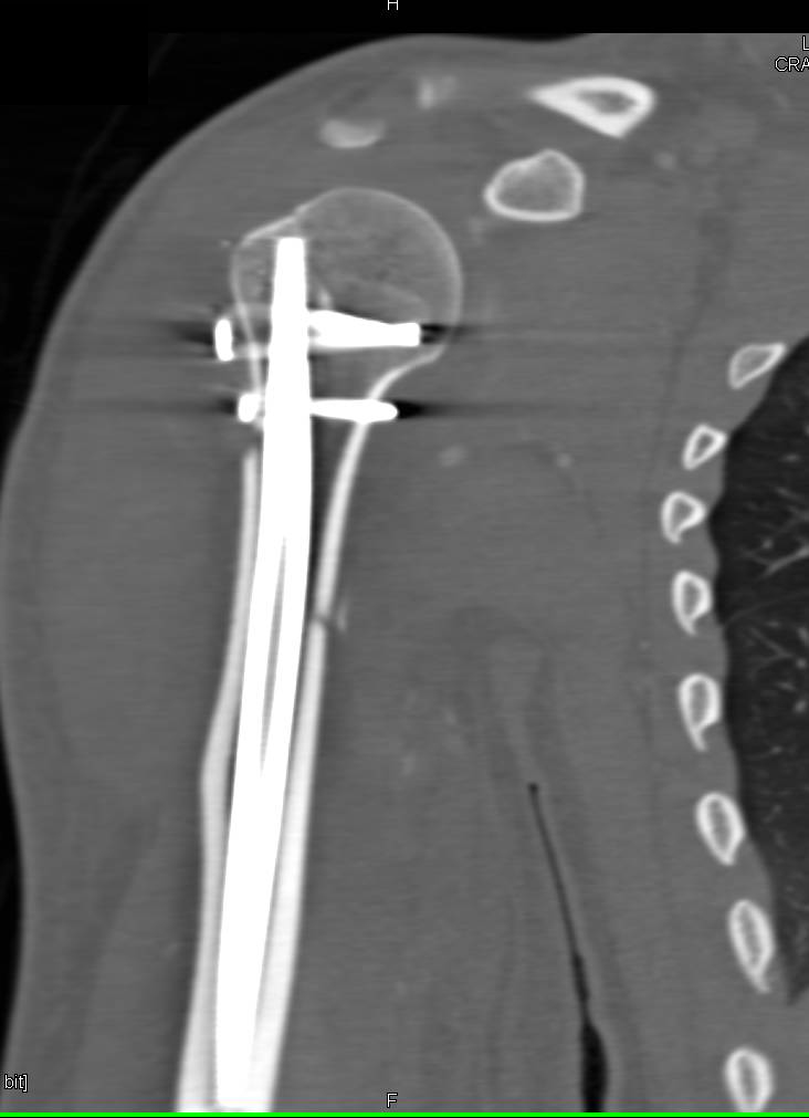 Humerus Fracture with Repair - CTisus CT Scan