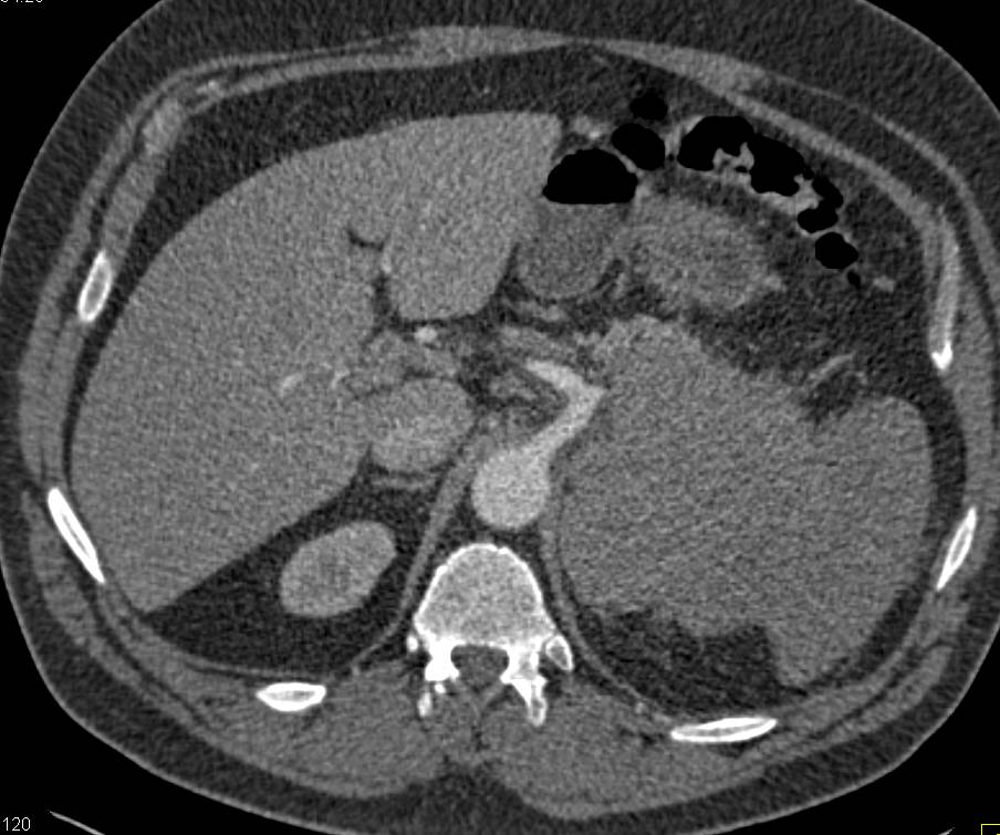 Left Adrenal Lymphoma - CTisus CT Scan