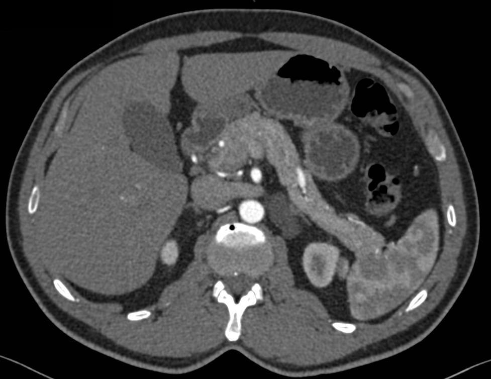 Lymphangioma - CTisus CT Scan