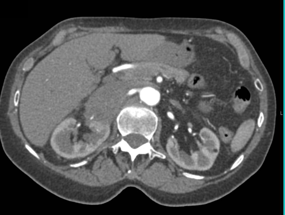 Adrenal Metastases from Lung Primary with Adrenal Artery Feeding Mass - CTisus CT Scan