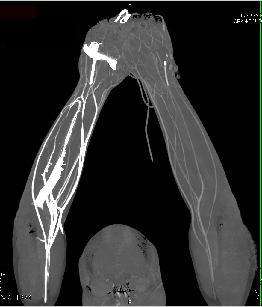 CTA Upper Extremities in Trauma Patient - CTisus CT Scan