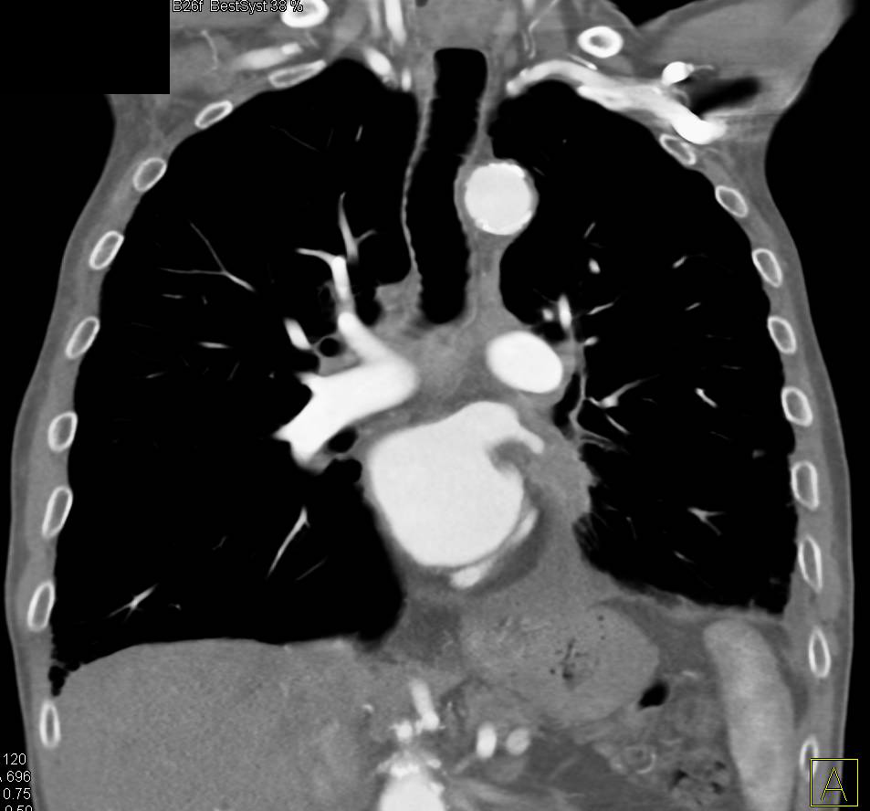 Metastatic Non-small Cell Lung Cancer to Right Adrenal - CTisus CT Scan