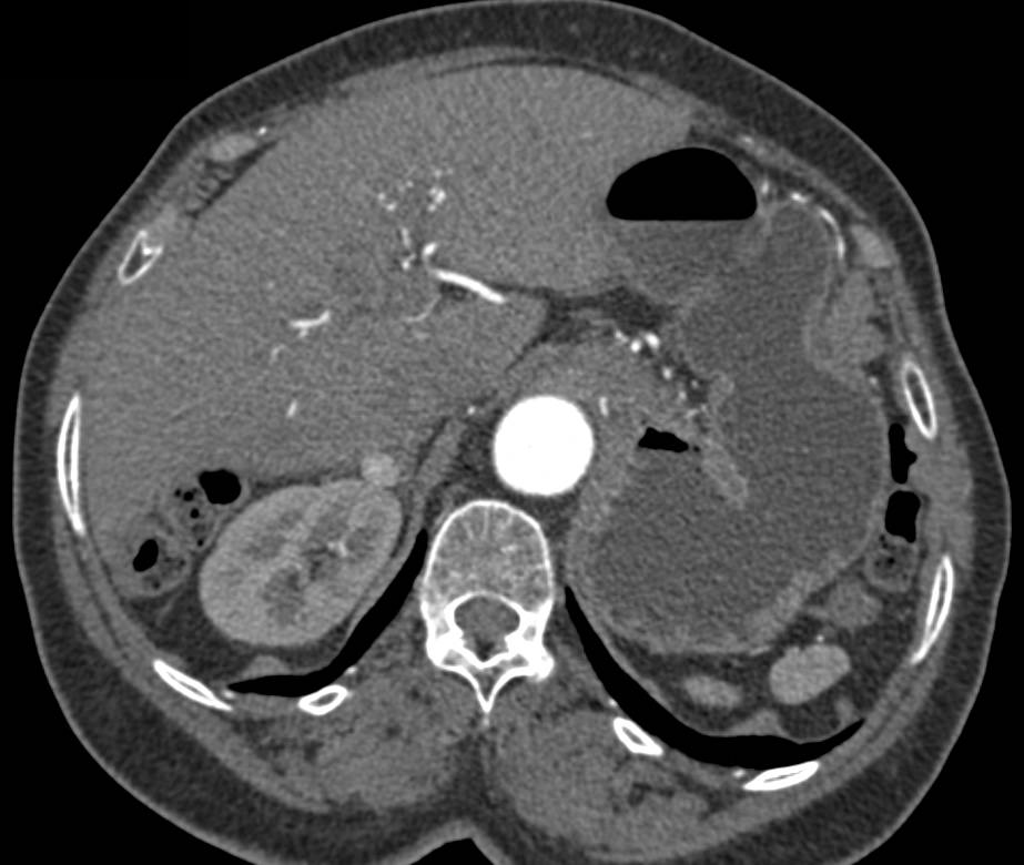 Metastatic Renal Cell Carcinoma to the Right Adrenal Gland and New Right Renal Cell Carcinoma - CTisus CT Scan
