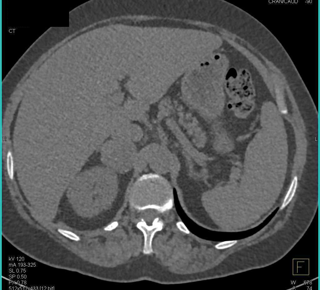 Metastatic Lung Cancer to the Adrenal - CTisus CT Scan