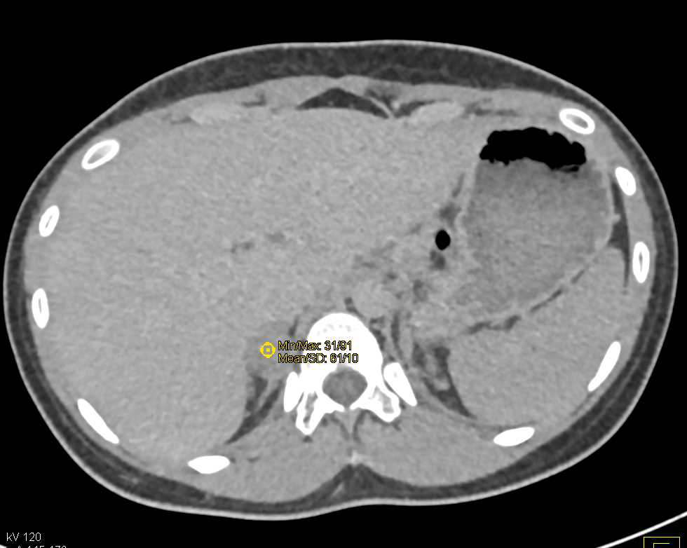 Right Adrenal Adenoma - CTisus CT Scan