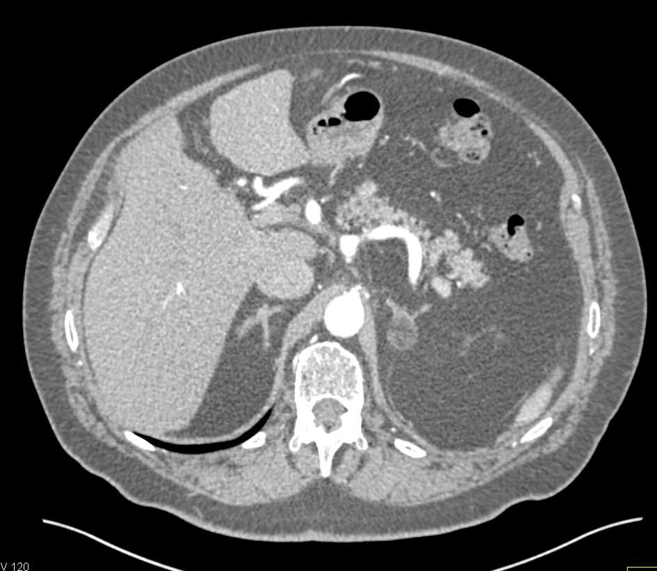 Myelolipoma Left Adrenal and Papillary Renal Cell Carcinoma (RCC) Left Kidney - CTisus CT Scan