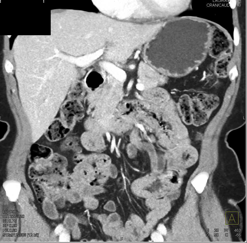 Duodenal Adenocarcinoma in 3rd Portion of the Duodenum - CTisus CT Scan