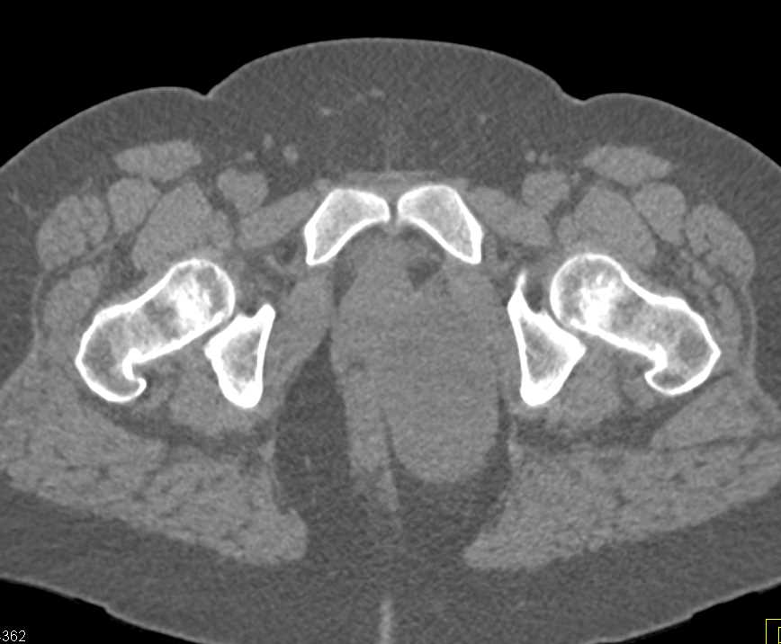 Neurofibroma in Left Ischiorectal Fossa - CTisus CT Scan