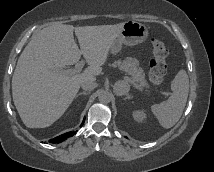 Left Adrenal Adenoma - CTisus CT Scan