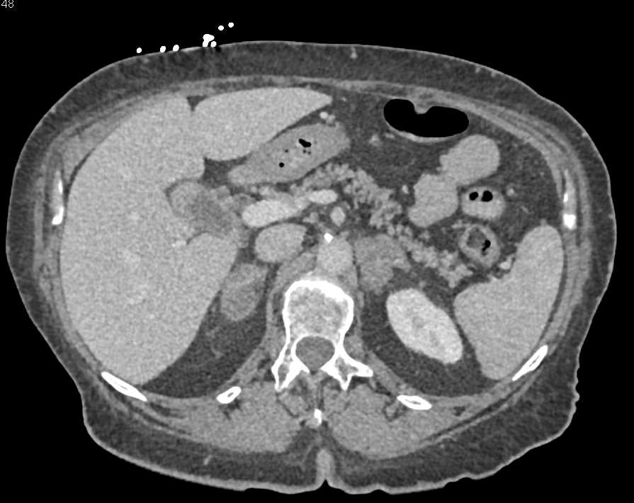 Metastases to the Lung and the Adrenal Gland - CTisus CT Scan