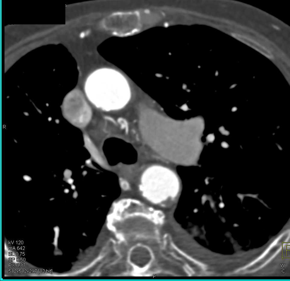 Poor Renal Function with Abnormal Renal Enhancement - CTisus CT Scan