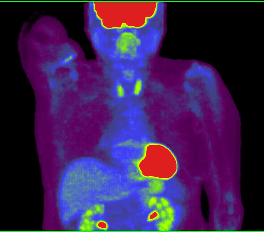 PET/CT Positive for Left Adrenal Adenoma as an Incidental Finding - CTisus CT Scan