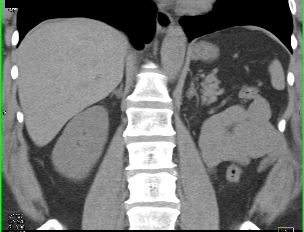 Left Nephrectomy with Tiny Nodule Left Adrenal Gland - CTisus CT Scan