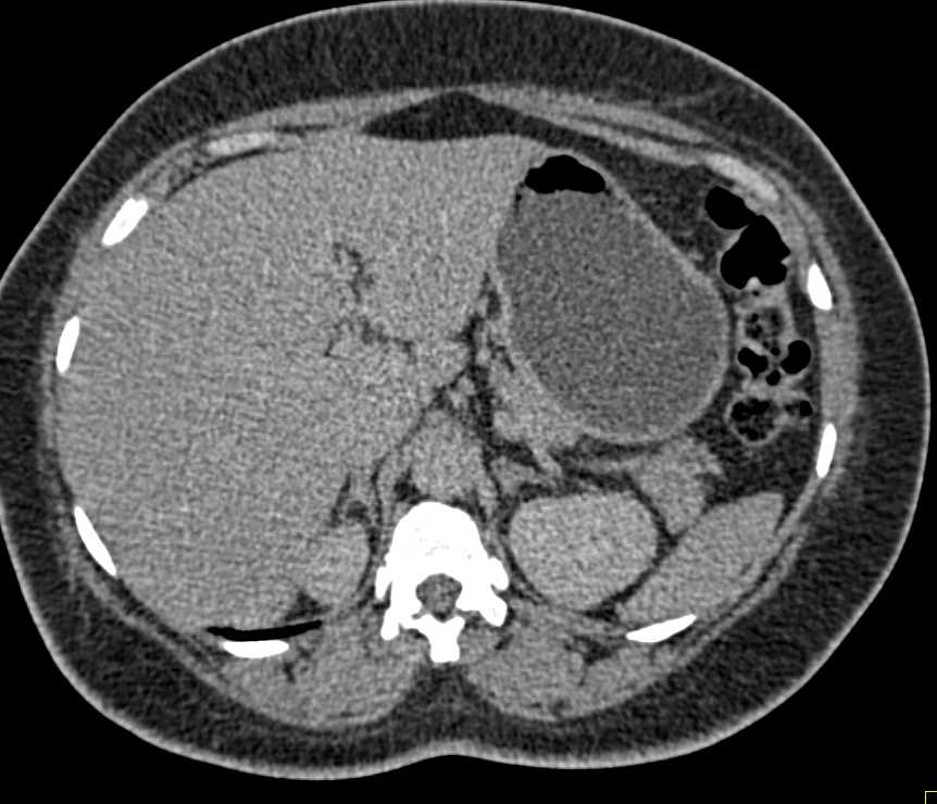 Normal Adrenal Glands - CTisus CT Scan