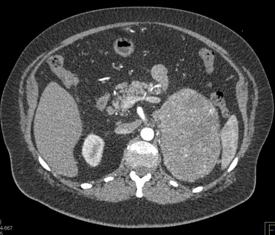 Adrenocortical Carcinoma - CTisus CT Scan