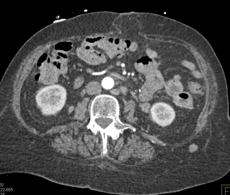 Metastatic Melanoma with Sites Including Adrenal Glands and adenopathy - CTisus CT Scan