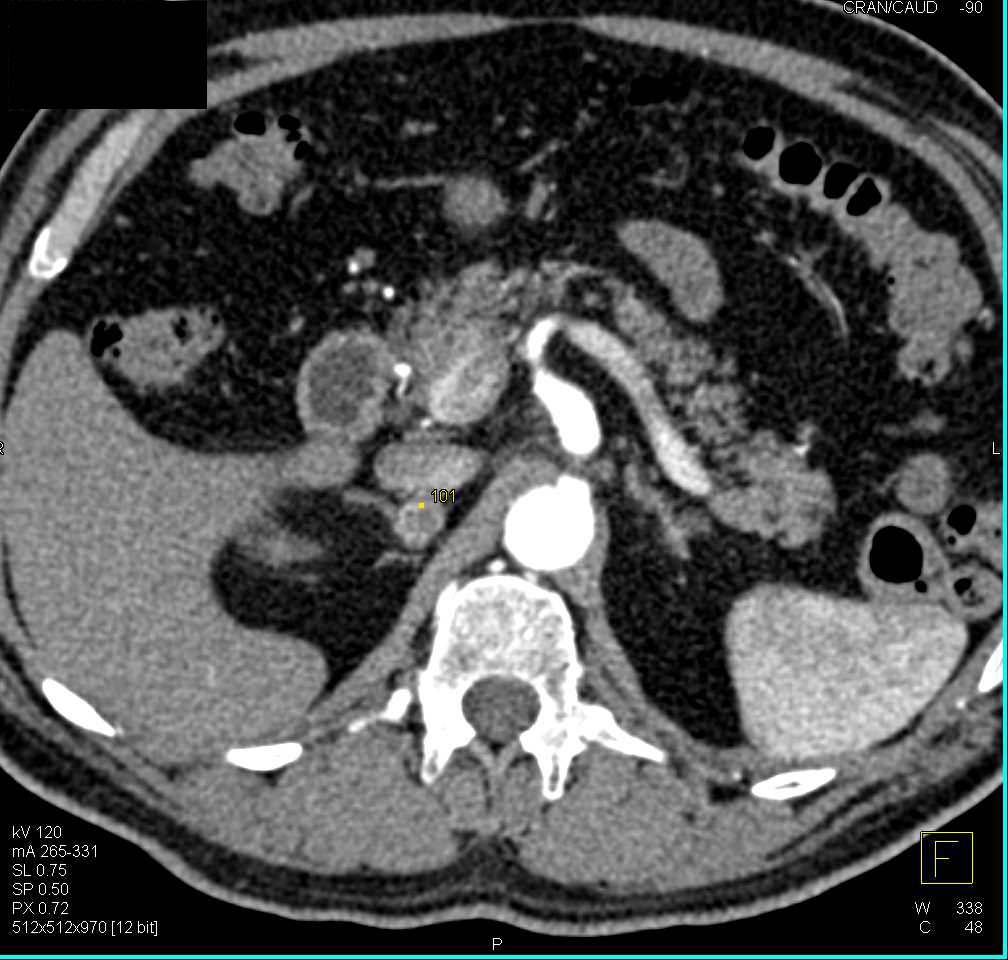 Metastatic Renal Cell Carcinoma to the Right Adrenal Gland - CTisus CT Scan