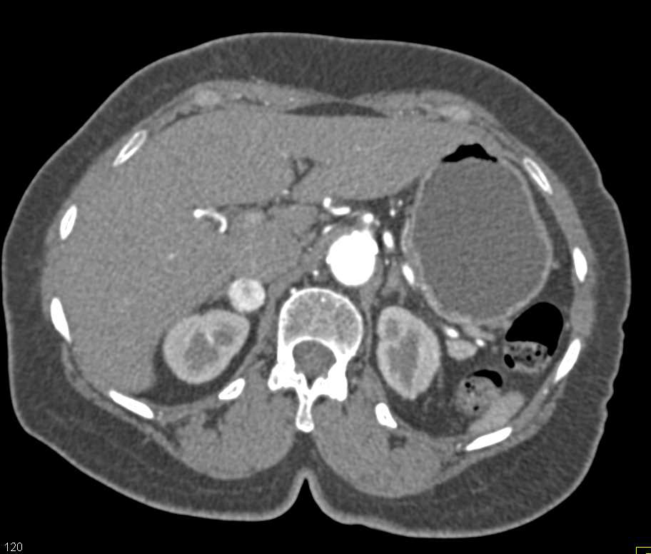 Incidental Pheochromocytoma - CTisus CT Scan
