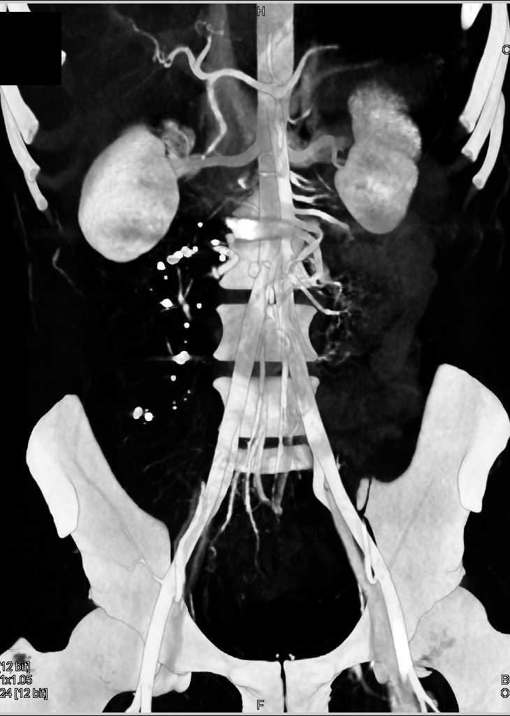 Bright Adrenals in GSW Patient Who Is Hypotensive - CTisus CT Scan