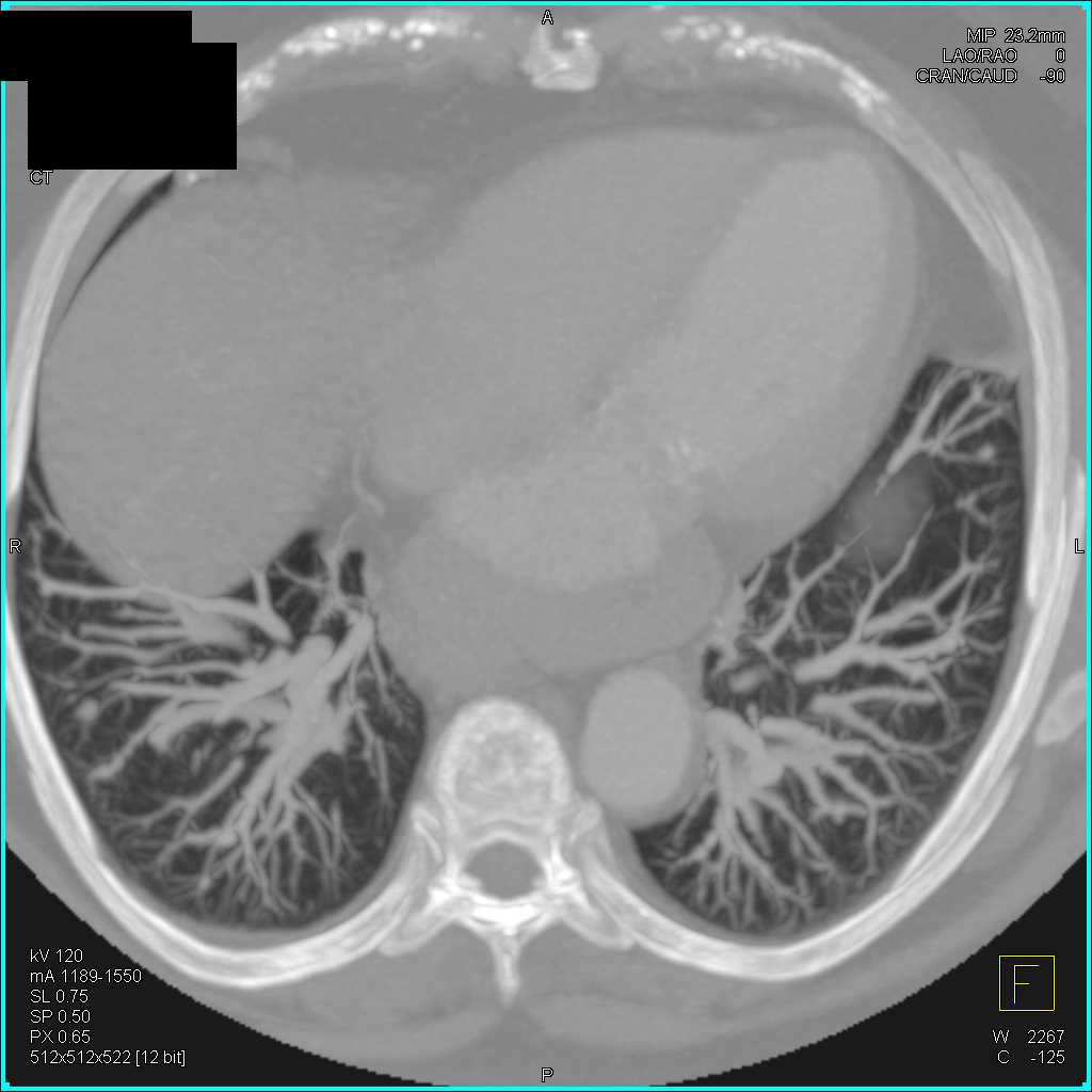 Multiple Small Pulmonary Arteriovenous Malformations (PAVMs) - CTisus CT Scan