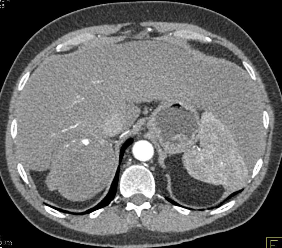 Right Adrenal Hematoma - CTisus CT Scan