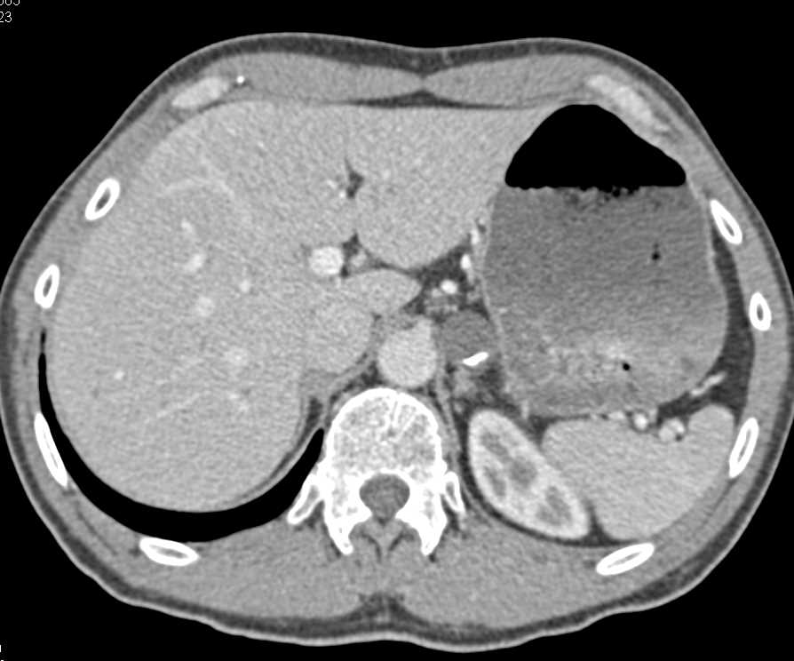 Adrenal Adenoma with Calcification - CTisus CT Scan