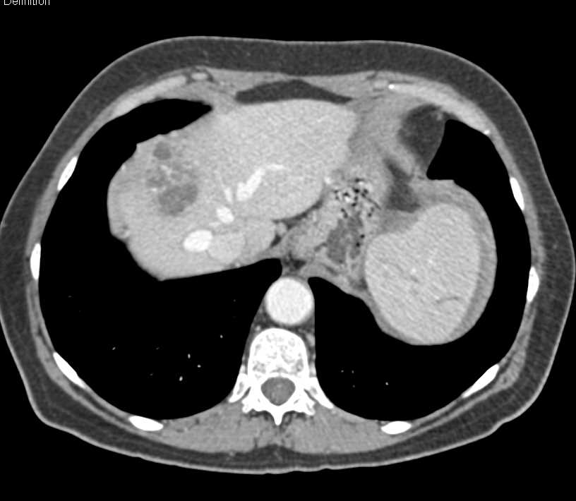 Splenic Rupture with Bleed - CTisus CT Scan