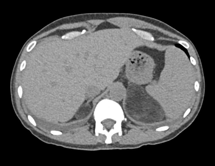 Bilateral Adrenal Myelolipomas - CTisus CT Scan