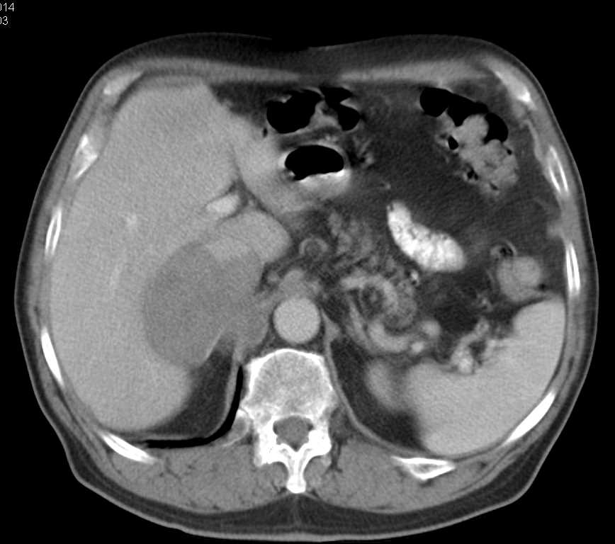 Adrenal Carcinoma Invades the Liver - CTisus CT Scan