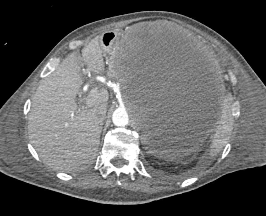 Large Left Adrenal Bleed - CTisus CT Scan