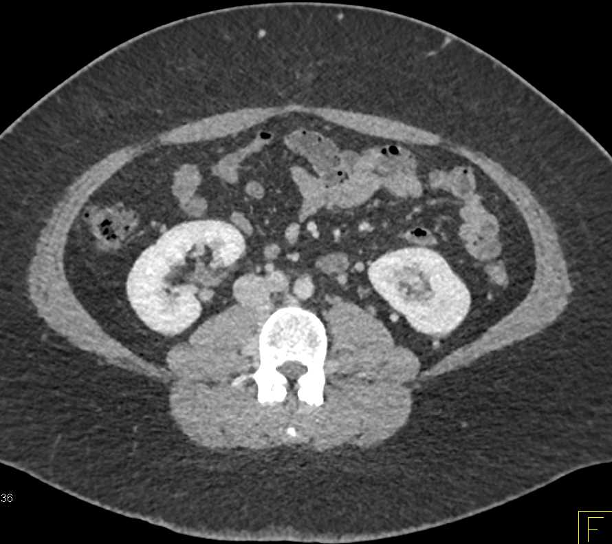 Calcified Right Adrenal Gland due to Prior Trauma - CTisus CT Scan