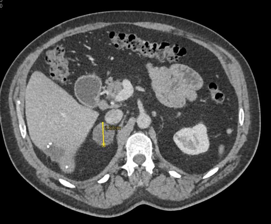 Right Adrenal Adenoma - CTisus CT Scan