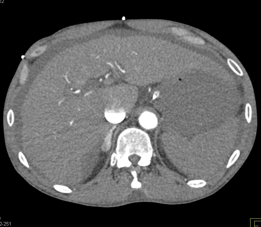 Bright Adrenal Glands Compatible with Hypotension - CTisus CT Scan