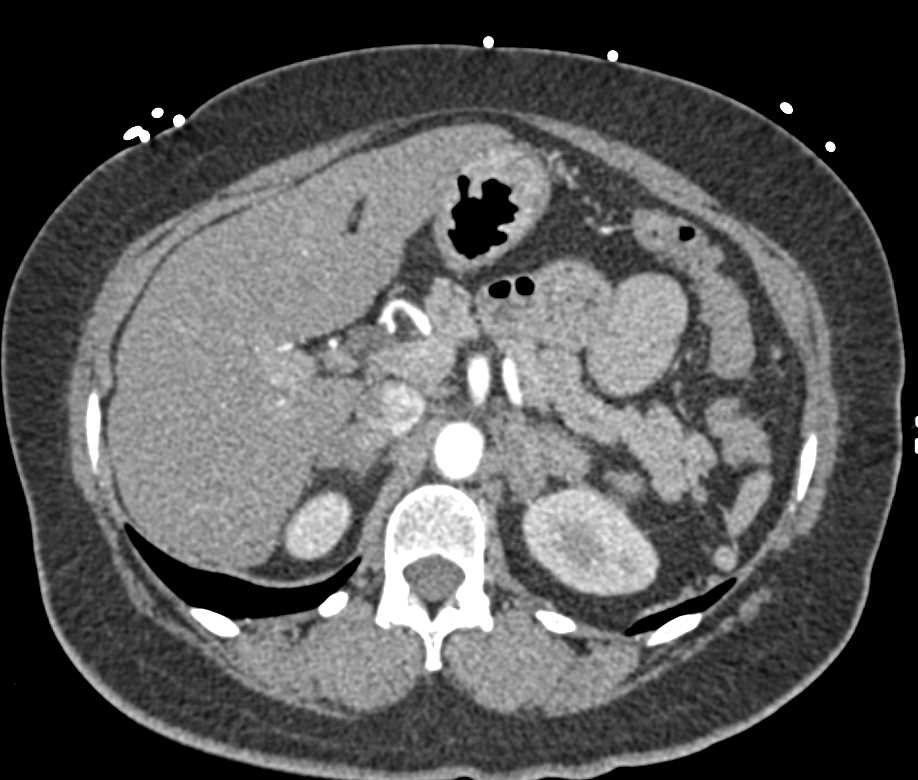 Bilateral Adrenal Hyperplasia - CTisus CT Scan