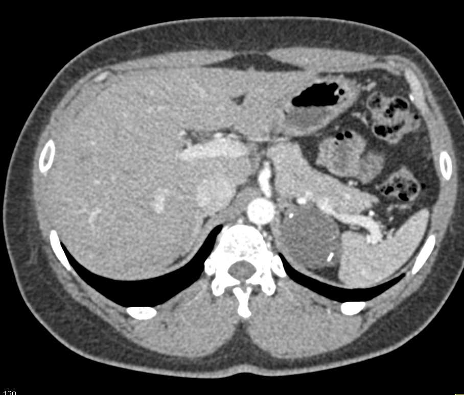 Left Adrenal Adenoma - CTisus CT Scan