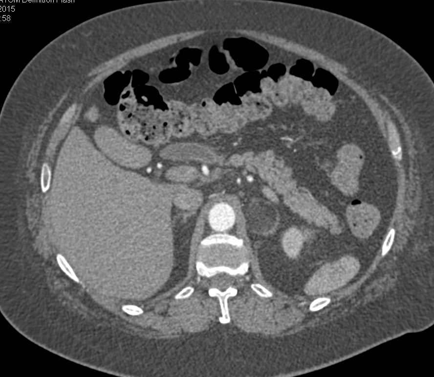 Left Adrenal Myelolipoma - CTisus CT Scan