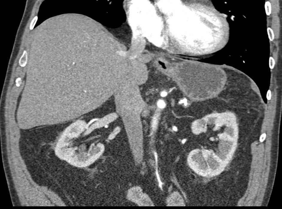 Bilateral Adrenal Calcification in Patient with Prior Hemorrhage - CTisus CT Scan