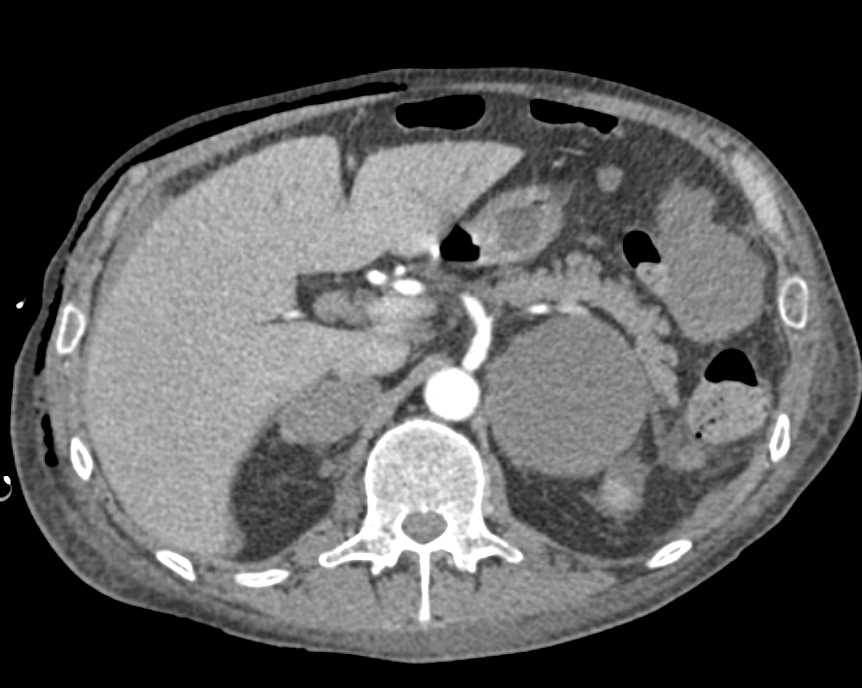 Metastatic Melanoma to the Adrenal Glands - CTisus CT Scan