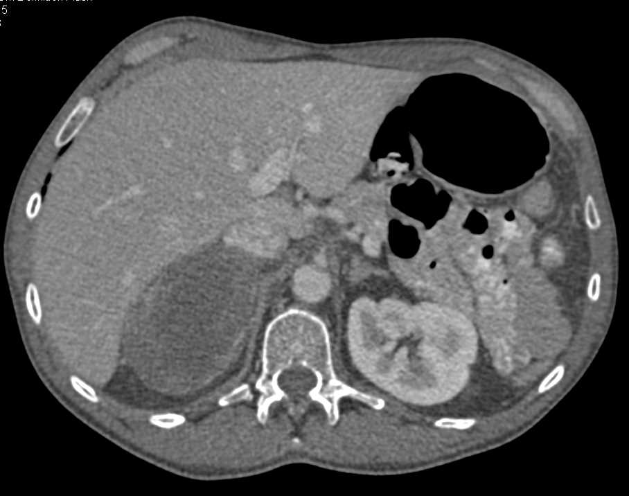 Adrenal Hematoma - CTisus CT Scan