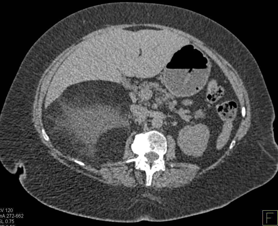 Large Right Adrenal Myelolipoma - CTisus CT Scan