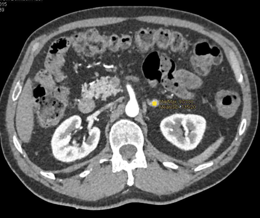 1cm Pheochromocytoma Left Adrenal Gland - CTisus CT Scan