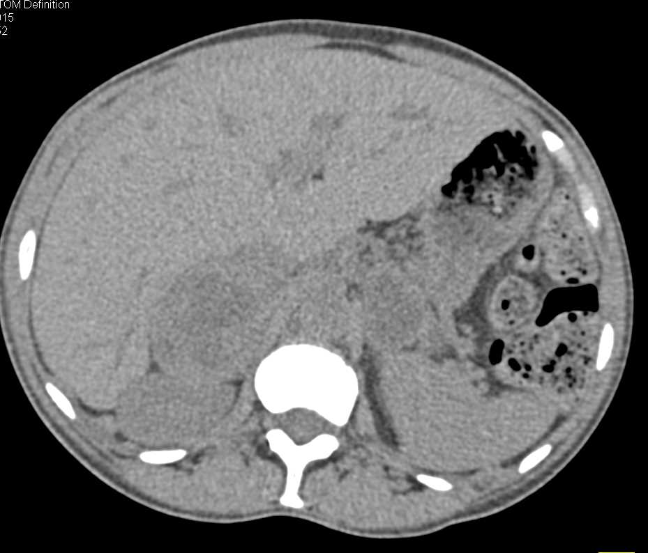 Metastatic Bladder Cancer to the Adrenal Glands - CTisus CT Scan