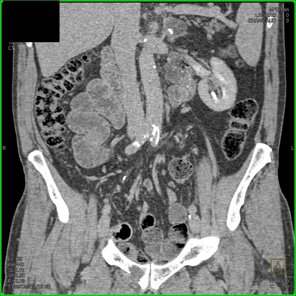 Incidental Left Adrenal Adenoma - CTisus CT Scan