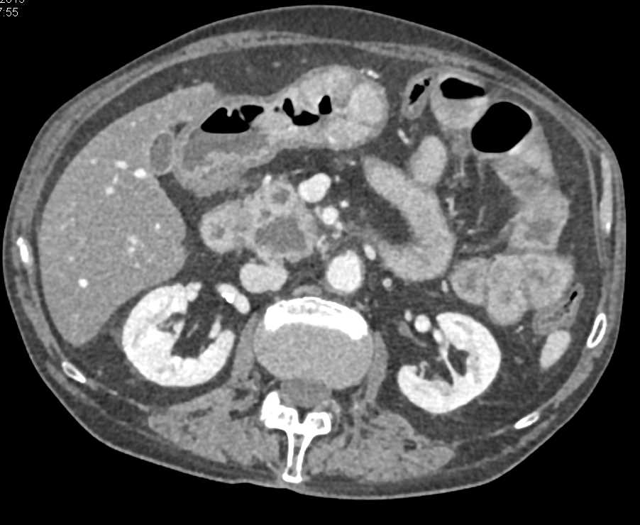 Inflammatory Bowel Disease (IBD) in a Patient With Glandular Atrophy - CTisus CT Scan
