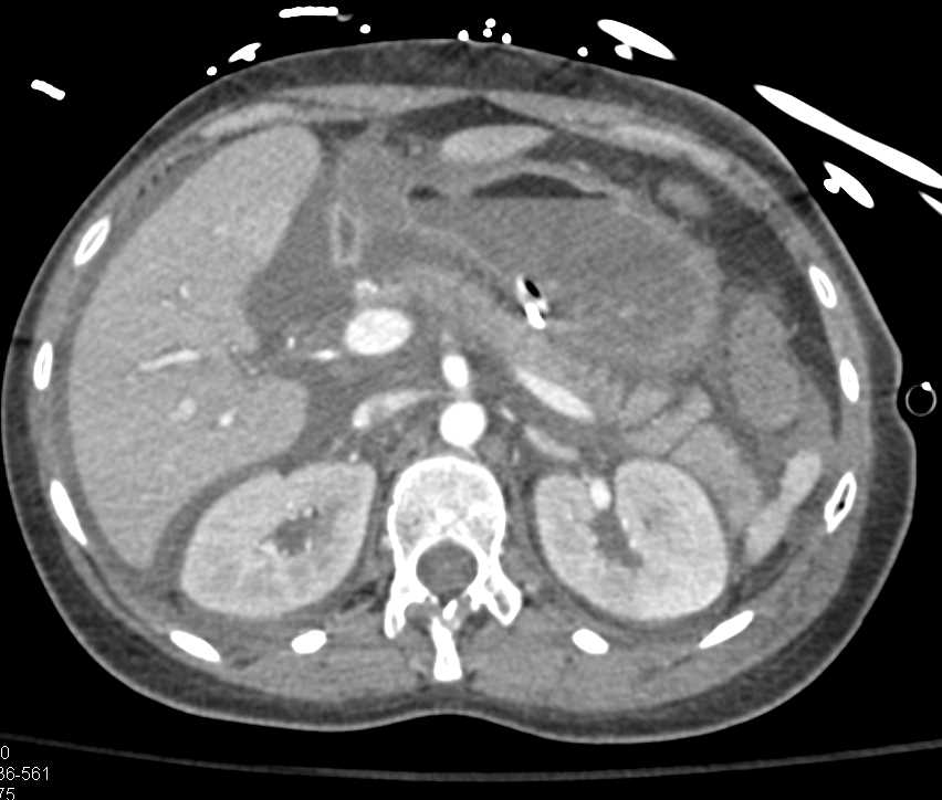 Bright Adrenal and Hypotension with Abdominal Bleed - CTisus CT Scan