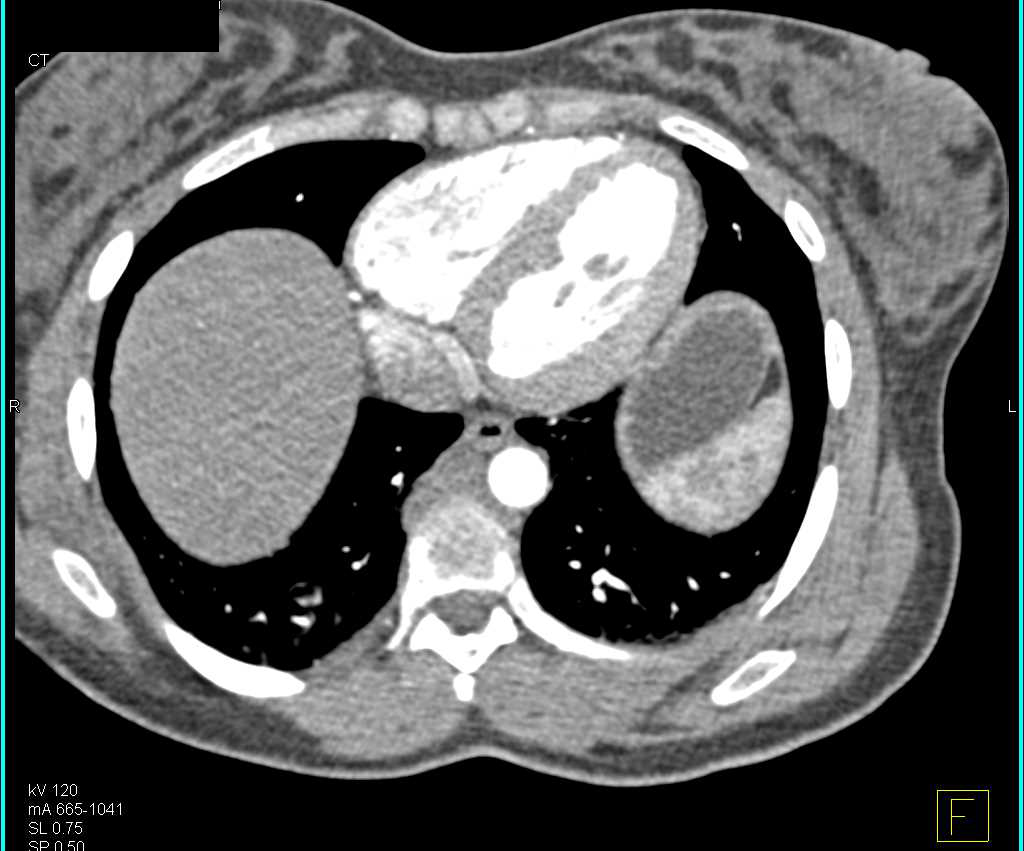Primary Left Adrenal Carcinoma - CTisus CT Scan